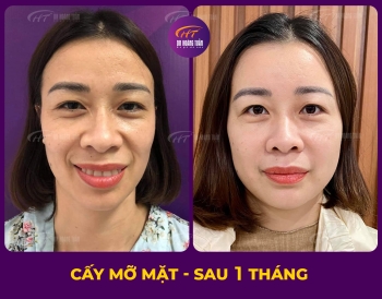 CẤY MỠ